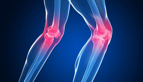 Rheumatoid Arthritis: