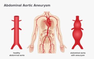 Abdominal Aortic Aneurysm: Causes, Symptoms, and Treatment 1 Abdominal aortic aneurysms