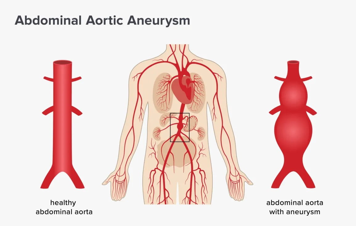 Abdominal aortic aneurysms