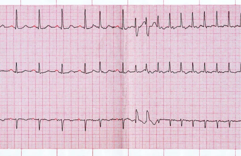 5 Must-Know Realities of Atrial Fibrillation: Empower Your Heart Health Journey Now! 1 Atrial Fibrillation