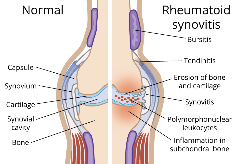 Rheumatoid Arthritis