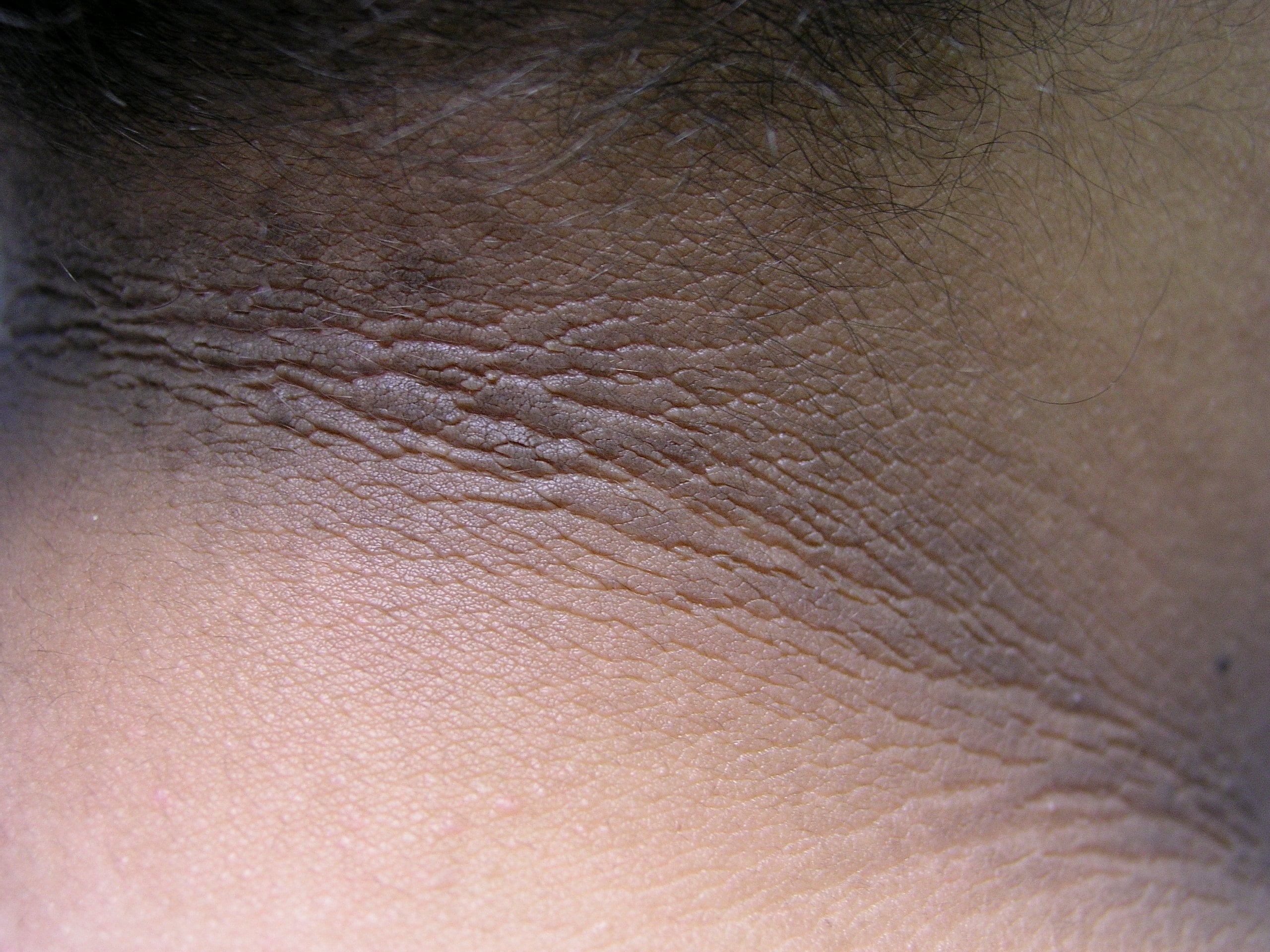 Acanthosis Nigricans