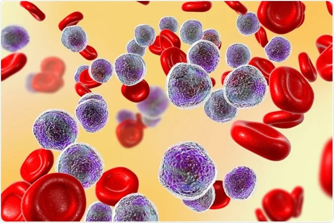 acute lymphocytic leukemia, acute lymphocytic leukemia symptoms, acute lymphocytic leukemia survival rate, acute lymphocytic leukemia treatment, acute lymphocytic leukemia icd 10, b cell acute lymphocytic leukemia, acute lymphocytic leukemia prognosis, acute lymphocytic leukemia in adults, acute lymphocytic leukemia signs and symptoms, acute lymphocytic leukemia pathophysiology, acute lymphocytic leukemia risk factors, acute lymphocytic leukemia all, acute lymphocytic leukemia age group, acute lymphocytic leukemia age, acute lymphocytic leukemia adults, acute lymphocytic leukemia assessment, acute lymphocytic leukemia and acute lymphoblastic leukemia, acute lymphocytic leukemia and chronic lymphocytic leukemia, acute lymphocytic leukemia article, acute lymphocytic leukemia b cell, acute lymphocytic leukemia bone marrow transplant, acute lymphocytic leukemia bone marrow, acute lymphocytic leukemia bone marrow biopsy, acute lymphocytic leukemia blood picture,