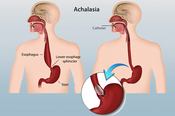 achalasia symptoms,achalasia definition,achalasia treatment,achalasia of esophagus,achalasia of cardia,