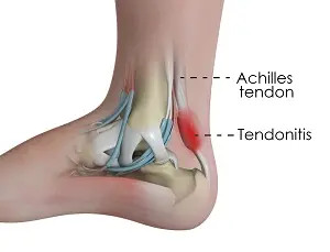 Achilles tendinitis, achilles tendinitis symptoms, achilles tendinitis treatment, achilles tendinitis medication, achilles tendinitis therapies, achilles tendinitis medical devices, achilles tendinitis stretching, achilles tendinitis stretching, achilles tendonitis brace, achilles tendinitis surgery, achilles tendinitis recovery time, achilles tendinitis massage, achilles tendinitis exercises, achilles tendonitis treatment, achilles tendinitis causes, how to heal achilles tendinitis