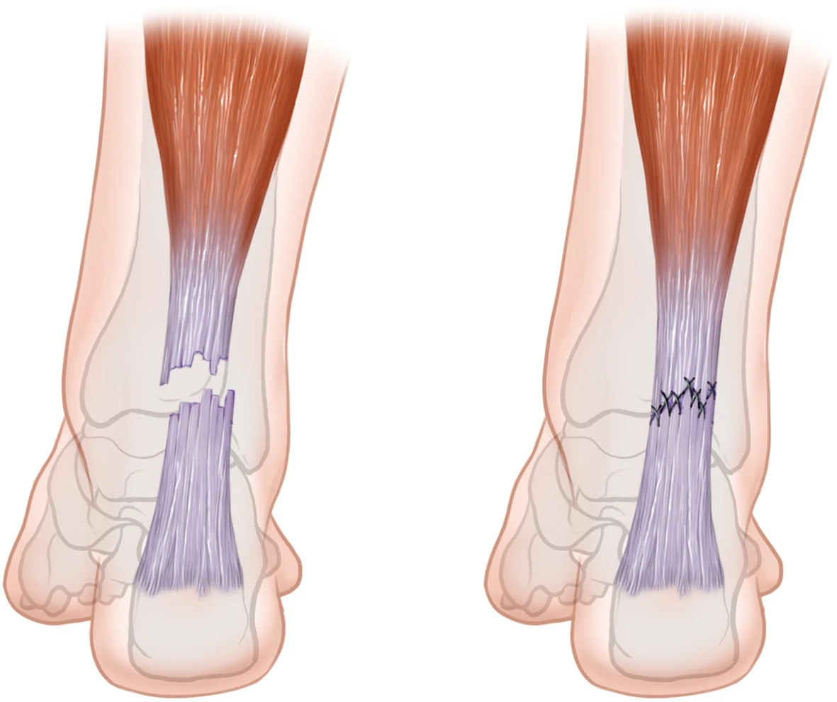 achilles tendon rupture, achilles tendon rupture treatment, life after achilles tendon rupture, achilles tendon rupture test, achilles tendon rupture surgery, achilles tendon rupture recovery time,achilles tendon rupture symptoms,