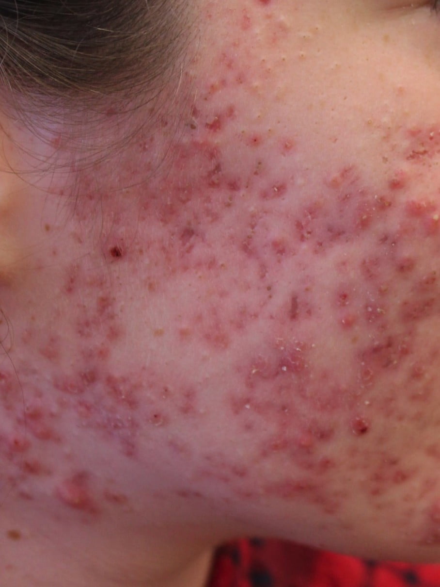 acne, cystic acne, fungal acne, baby acne, hormonal acne, how to get rid of acne scars, acne treatment, spironolactone for acne, how to get rid of acne, acne scars, acne studios, acne vulgaris, nodular acne