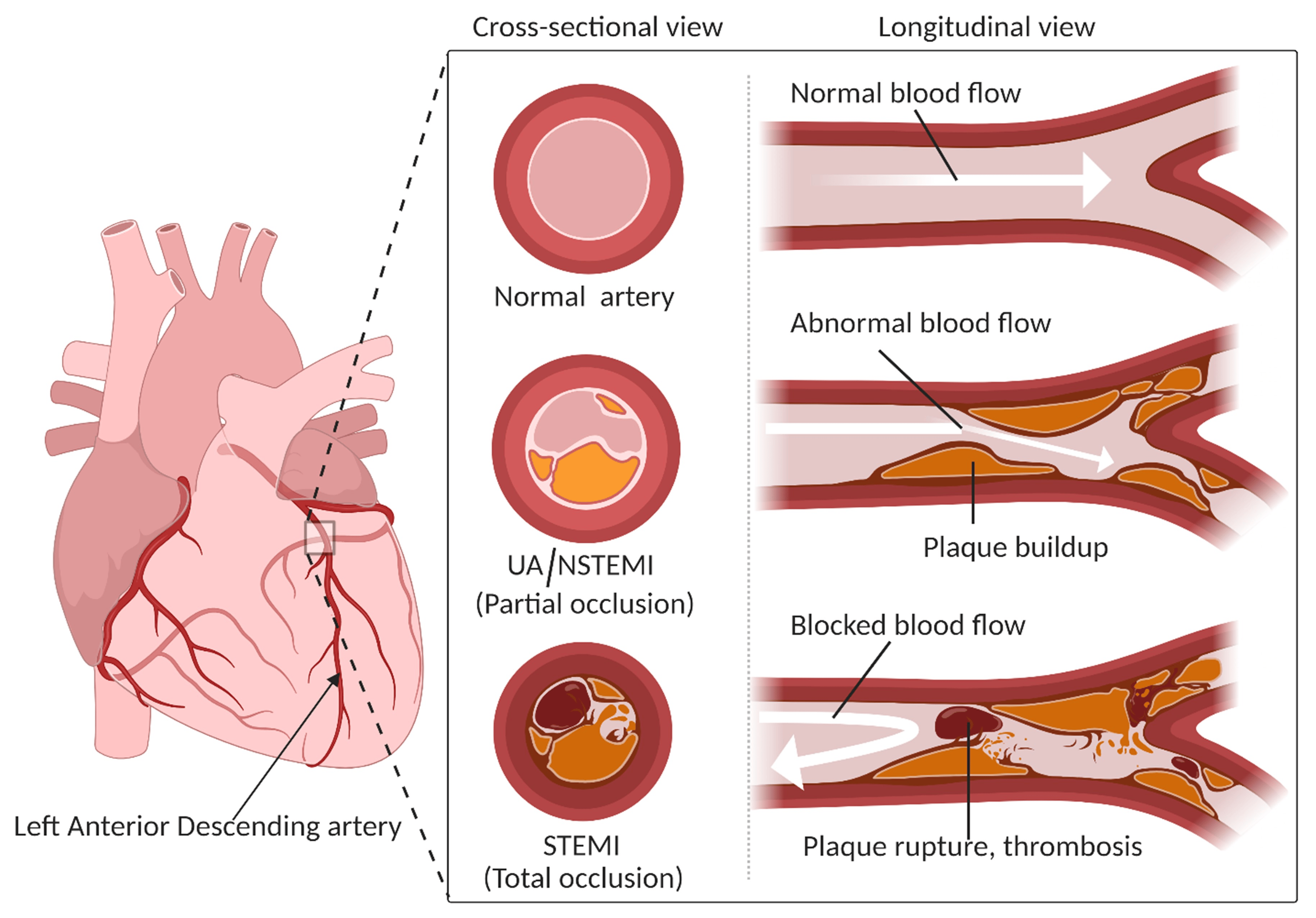 acute coronary syndrome, acute coronary syndrome symptoms,what is acute coronary syndrome,acute coronary syndrome icd 10, acute coronary syndrome treatment,