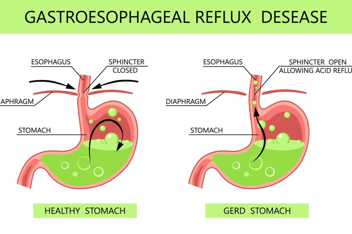 gastroesophageal reflux disease symptoms, gastroesophageal reflux disease, gastroesophageal reflux disease treatments, gastroesophageal reflux disease medication, gastroesophageal reflux disease without esophagitis, gastroesophageal reflux disease icd 10, gastroesophageal reflux disease self-care, gastroesophageal reflux disease pronunciation, gastroesophageal reflux disease in spanish, gastroesophageal reflux disease va rating, gastroesophageal reflux disease or gerd is similar to, gastroesophageal reflux disease abdominal pain, gastroesophageal reflux disease abbreviation medical, gastroesophageal reflux disease age range, gastroesophageal reflux disease and coffee, gastroesophageal reflux disease age, gastroesophageal reflux disease and cancer, gastroesophageal reflux disease and hiatal hernia, gastroesophageal reflux disease and anemia,