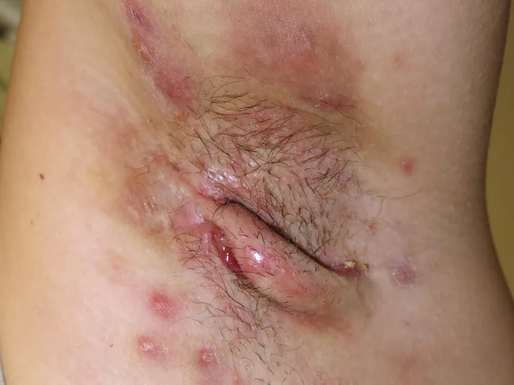 hidradenitis suppurativa