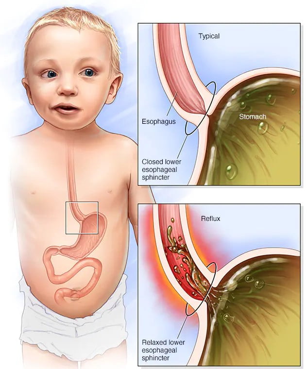 Infant Reflux