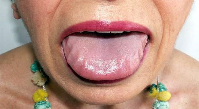 amyloidosis, amyloidosis symptoms, amyloidosis nhs, what is amyloidosis, cardiac amyloidosis, al amyloidosis, amyloidosis diagnosis, amyloidosis definition, amyloidosis heart, lichen amyloidosis, amyloidosis zero to finals, amyloidosis life expectancy, amyloidosis types, amyloidosis cancer, amyloidosis centre london, amyloidosis causes, amyloidosis and multiple myeloma, amyloidosis disease, amyloidosis medication, amyloidosis and myeloma, cardiac amyloidosis treatment, amyloidosis and alzheimer's, amyloidosis and dementia, attr amyloidosis,
