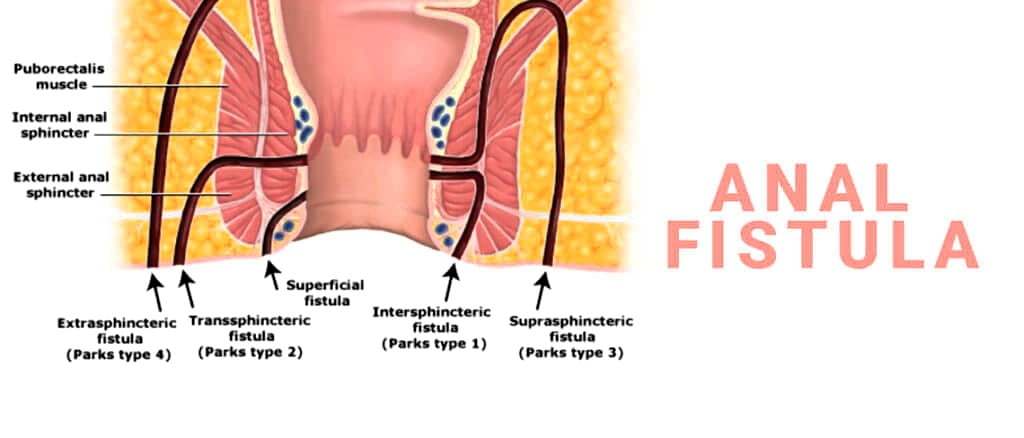 anal fistula, what is anal fistula, anal fistula symptoms, anal fistula treatment, what is an anal fistula, anal fistula surgery, anal fistula picture, anal fistula causes, what causes anal fistula, anal fistula surgery recovery, anal fistula images, anal fistula complications, anal fistula meaning, anal fistula abscess, anal fistula antibiotics, anal fistula after surgery, anal fistula icd 10, anal fistula adalah, anal fistula bleeding, anal fistula cancer, anal fistula cream, anal fistula cure, anal fistula diagnosis, anal fistula doctor, anal fistula fistulotomy, anal fistula home remedies, anal fistula icd 10,