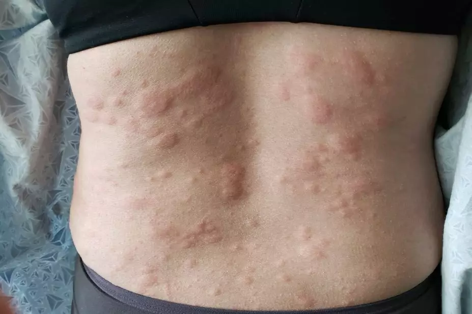 anaphylaxis, what is anaphylaxis, define anaphylaxis, anaphylaxis symptoms, symptoms of anaphylaxis, signs of anaphylaxis, 4 stages of anaphylaxis, anaphylaxis meaning, anaphylaxis treatment, anaphylaxis is described as, anaphylaxis algorithm, anaphylaxis uk, anaphylaxis adrenaline dose, anaphylaxis shock, anaphylaxis algorithm uk, anaphylaxis adrenaline dose child, anaphylaxis als, can i die in sleep from anaphylaxis, anaphylaxis allergy,