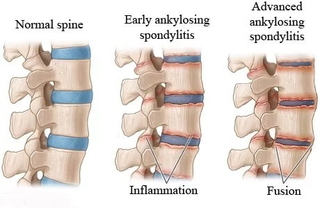 ankylosing spondylitis, ankylosing spondylitis treatment, ankylosing spondylitis definition, ankylosing spondylitis symptoms, what is ankylosing spondylitis, ankylosing spondylitis symptoms females, ankylosing spondylitis autoimmune, ankylosing spondylitis medication, how i cured my ankylosing spondylitis, ankylosing spondylitis icd 10, ankylosing spondylitis diagnosis, symptoms of ankylosing spondylitis, ankylosing spondylitis test, ankylosing spondylitis self-care, ankylosing spondylitis zero to finals, ankylosing spondylitis blood test, ankylosing spondylitis meaning, ankylosing spondylitis life expectancy, ankylosing spondylitis autoimmune, ankylosing spondylitis age of onset, ankylosing spondylitis and pregnancy, ankylosing spondylitis and fibromyalgia, ankylosing spondylitis association, ankylosing spondylitis antibodies, ankylosing spondylitis autoimmune disease,
