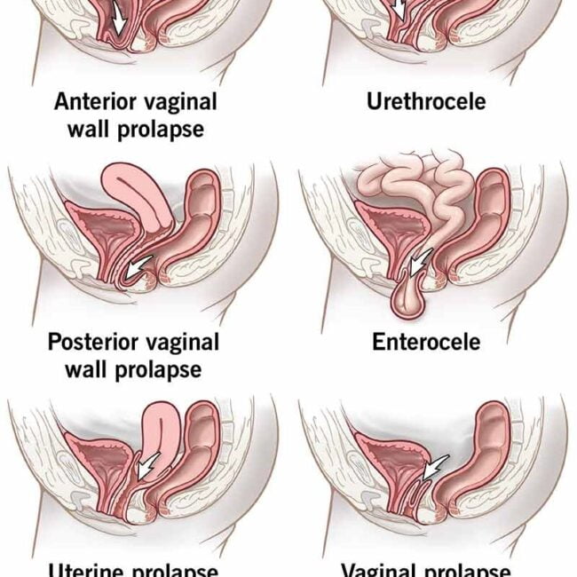 anterior vaginal prolapse, anterior vaginal prolapse (cystocele), anterior vaginal prolapse (cystocele), what is anterior prolapse, how do you fix an anterior prolapse, what does an anterior prolapse look like, what is a prolapsed bladder and uterus, what causes anterior prolapse, anterior vaginal wall.prolapse, anterior vaginal wall repair, anterior wall prolapse grading, anterior vaginal wall prolapse, anterior uterine wall prolapse, anterior vaginal prolapse repair, anterior vaginal prolapse icd 10, anterior vaginal prolapse cystocele, anterior vaginal prolapse surgery,