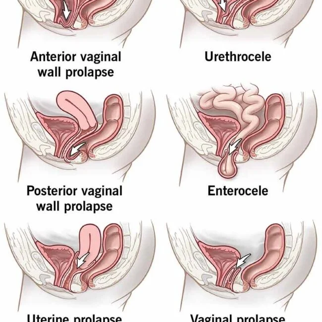 anterior vaginal prolapse, anterior vaginal prolapse (cystocele), anterior vaginal prolapse (cystocele), what is anterior prolapse, how do you fix an anterior prolapse, what does an anterior prolapse look like, what is a prolapsed bladder and uterus, what causes anterior prolapse, anterior vaginal wall.prolapse, anterior vaginal wall repair, anterior wall prolapse grading, anterior vaginal wall prolapse, anterior uterine wall prolapse, anterior vaginal prolapse repair, anterior vaginal prolapse icd 10, anterior vaginal prolapse cystocele, anterior vaginal prolapse surgery,