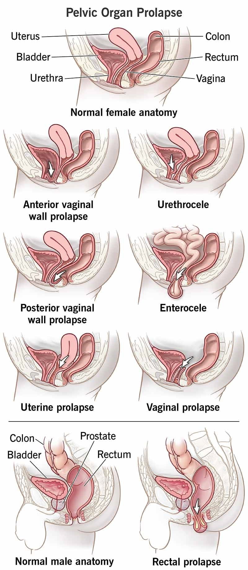 anterior vaginal prolapse, anterior vaginal prolapse (cystocele), anterior vaginal prolapse (cystocele), what is anterior prolapse, how do you fix an anterior prolapse, what does an anterior prolapse look like, what is a prolapsed bladder and uterus, what causes anterior prolapse, anterior vaginal wall.prolapse, anterior vaginal wall repair, anterior wall prolapse grading, anterior vaginal wall prolapse, anterior uterine wall prolapse, anterior vaginal prolapse repair, anterior vaginal prolapse icd 10, anterior vaginal prolapse cystocele, anterior vaginal prolapse surgery,