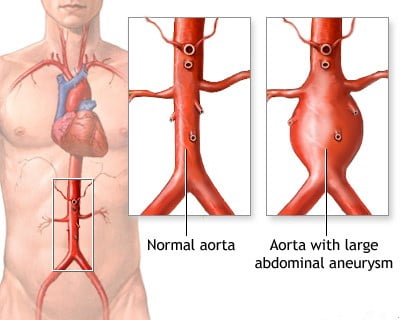 aortic aneurysm, aortic aneurysm symptoms, ascending aortic aneurysm, aortic aneurysm treatment, thoracic aortic aneurysm, dissecting aortic aneurysm, abdominal aortic aneurysm screening, infrarenal abdominal aortic aneurysm, how dangerous is a 4 cm aortic aneurysm, aortic aneurysm screening, aortic aneurysm surgery, aortic aneurysm causes, aortic aneurysm in females symptoms, aortic aneurysm death painful, aortic aneurysm meaning, aortic aneurysm symptoms before rupture,
