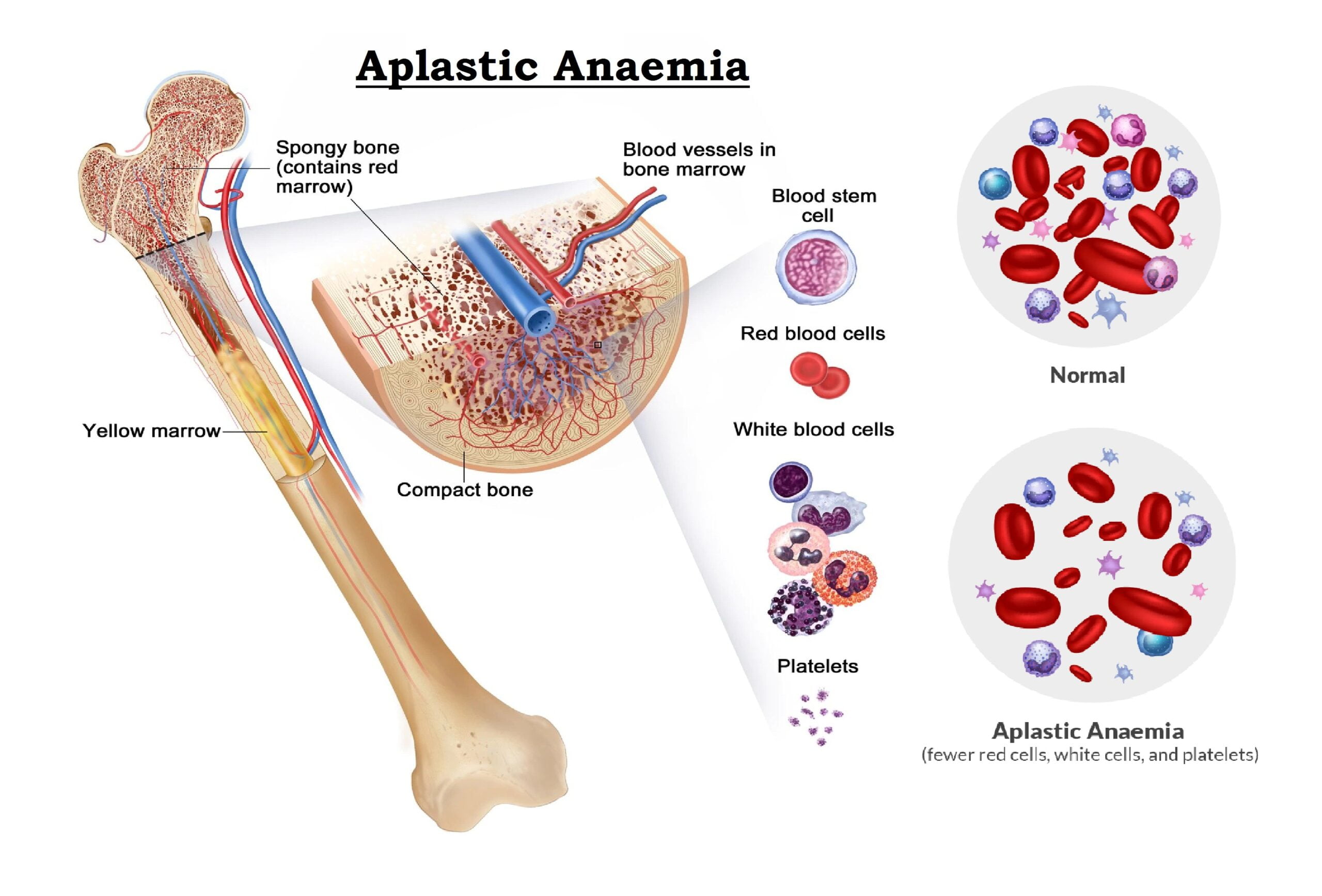 aplastic anemia, what is aplastic anemia, aplastic anemia definition, severe aplastic anemia, aplastic anemia symptoms, aplastic anemia treatment, aplastic anemia icd 10, is aplastic anemia cancer, aplastic anemia nhs, aplastic anemia cancer, idiopathic aplastic anemia, aplastic anemia causes, aplastic anemia in adults nhs, aplastic anemia diagnosis, aplastic anemia meaning, aplastic anemia specialists, aplastic anemia symptoms nhs, aplastic anemia adults, aplastic anemia and leukemia, aplastic anemia acquired, aplastic anemia and pregnancy, aplastic anemia and exercise, aplastic anemia blood test, aplastic anemia bone marrow,