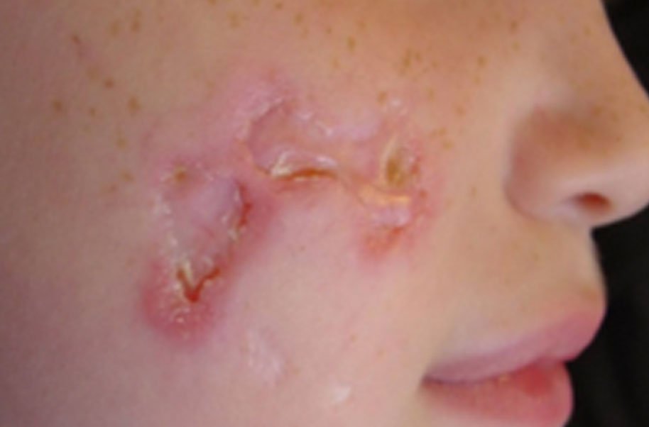 churg-strauss syndrome, churg-strauss syndrome nhs, churg-strauss syndrome criteria, churg-strauss syndrome stages, churg-strauss syndrome icd 10, churg-strauss syndrome triad, churg-strauss syndrome life expectancy, churg-strauss syndrome caused by which drug, new treatment for churg-strauss syndrome, is churg-strauss syndrome fatal, churg-strauss syndrome diagnosis, churg-strauss syndrome rash, churg-strauss syndrome montelukast, churg-strauss syndrome wiki, churg-strauss syndrome and leukotriene receptor antagonists, churg-strauss syndrome asthma, churg strauss syndrome antibody, churg strauss syndrome anca type,