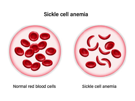 sickle cell anemia, sickle cell anemia definition, sickle cell anemia symptoms, symptoms of sickle cell anemia, what is sickle cell anemia, treatment for sickle cell anemia, what causes sickle cell anemia, sickle cell anemia treatment, sickle cell anemia mutation, sickle cell anemia genetics, sickle cell anemia inheritance, sickle cell anemia nhs, how is sickle cell anemia inherited, sickle cell anemia life expectancy, sickle cell anemia and malaria, sickle cell anemia causes, sickle cell anemia cure, sickle cell anemia icd 10,