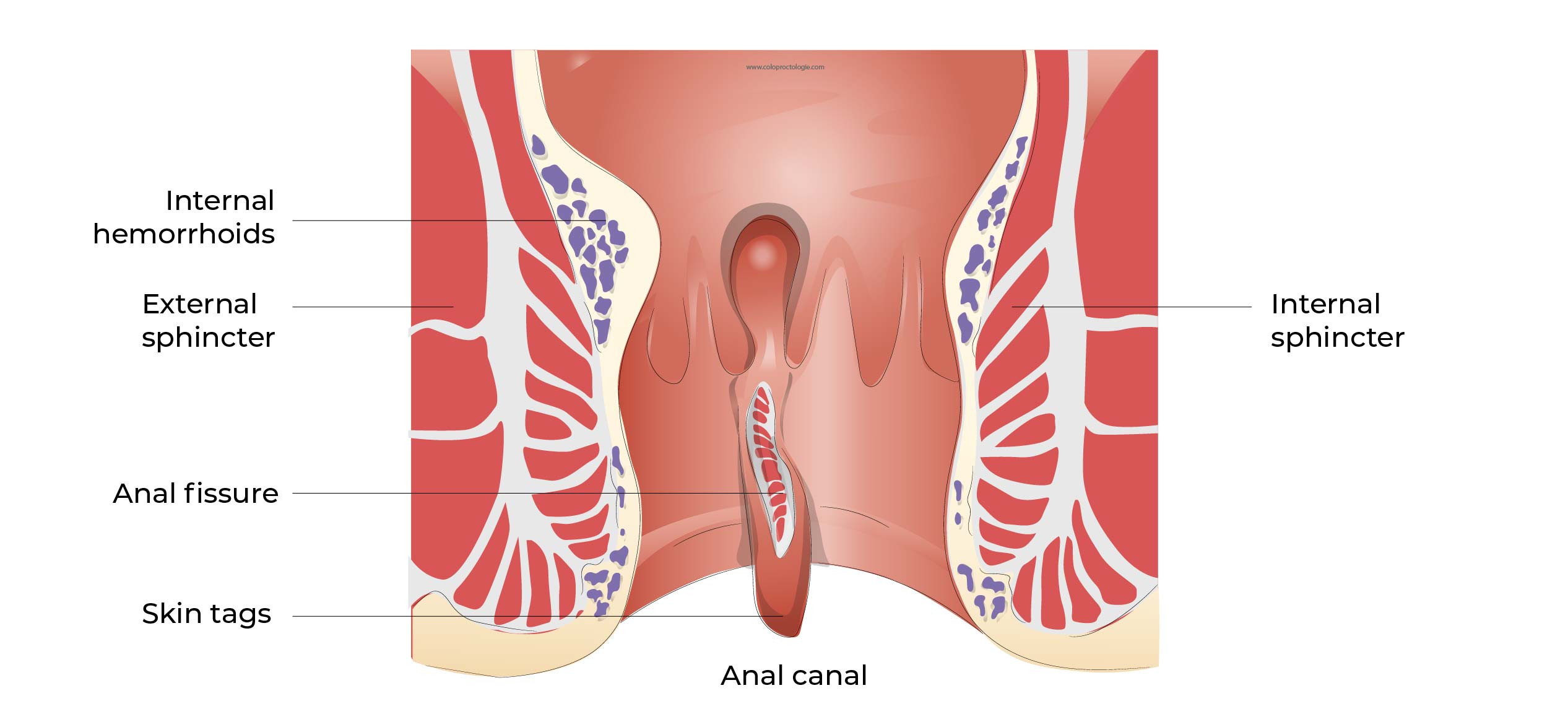 anal fissure, anal fissure treatments, anal fissure symptoms, anal fissure cream, best ointment for anal fissure, how to heal anal fissure, chronic anal fissure symptoms, hemorrhoids or an anal fissure, anal fissure self-care, anal fissure medication, anal fissure nhs, anal fissure causes, anal fissure surgery, anal fissure medical procedure, anal fissure healing time, anal fissure treatment at home, anal fissure pain, anal fissure and piles, anal fissure and hemorrhoids, anal fissure antibiotics, anal fissure and constipation, anal fissure at home treatment, anal fissure anatomy,