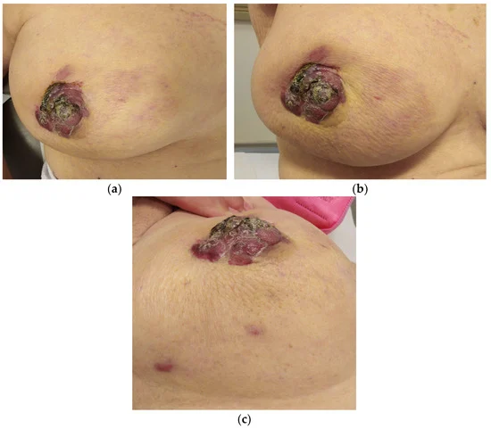 angiosarcoma, angiosarcoma of breast, cardiac angiosarcoma, angiosarcoma cancer, epithelioid angiosarcoma, cutaneous angiosarcoma, hepatic angiosarcoma, angiosarcoma symptoms, angiosarcoma pathology outlines, angiosarcoma pictures, angiosarcoma liver, angiosarcoma treatment, angiosarcoma prognosis, angiosarcoma adalah, angiosarcoma after breast cancer, angiosarcoma awareness, angiosarcoma and hemangiosarcoma, angiosarcoma after breast cancer radiation, angiosarcoma after mastectomy, angiosarcoma breast, angiosarcoma breast treatment, angiosarcoma brain, angiosarcoma bone radiology, angiosarcoma breast life expectancy, angiosarcoma bone, angiosarcoma breast ultrasound, angiosarcoma biopsy, angiosarcoma cancer, angiosarcoma cardiac, angiosarcoma chemotherapy,