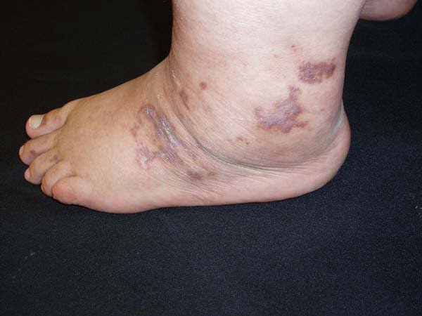 antiphospholipid syndrome, antiphospholipid syndrome symptoms, antiphospholipid syndrome treatment, what is antiphospholipid syndrome, catastrophic antiphospholipid syndrome, antiphospholipid syndrome icd 10, antiphospholipid syndrome medication, antiphospholipid syndrome specialist doctor, antiphospholipid syndrome treatments, antiphospholipid syndrome zero to finals, antiphospholipid syndrome in pregnancy, antiphospholipid syndrome antibodies, antiphospholipid syndrome test, antiphospholipid syndrome nhs, antiphospholipid syndrome diagnosis, antiphospholipid syndrome blood test, antiphospholipid syndrome and pregnancy antiphospholipid syndrome and lupus,