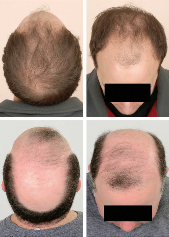 hair loss, hair loss treatment, does creatine cause hair loss, hair loss in women, best shampoo for hair loss, postpartum hair loss, anti hair loss shampoo, hair loss causes, what causes hair loss, alopecia hair loss, which vitamin deficiency causes hair loss, ozempic hair loss suicidal thoughts, hair loss treatment for women, hair loss treatment for men, hair loss after pregnancy, hair loss tablets, how to prevent hair loss, prp for hair loss, hair loss medication, hair loss alopecia, hair loss after covid, finasteride for hair loss, spironolactone for hair loss,