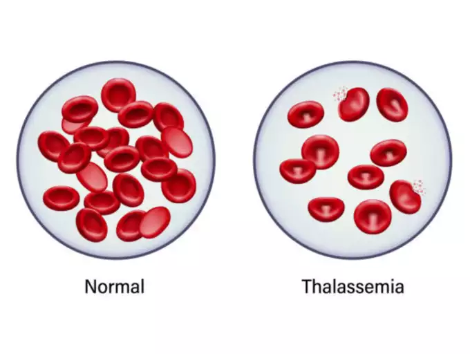 thalassemia, thalassemia trait, alpha thalassemia, beta thalassemia, thalassemia symptoms, thalassemia minor, thalassemia meaning, thalassemia treatment, thalassemia carrier, thalassemia trait symptoms, thalassemia major, thalassemia blood test, thalassemia alpha, thalassemia and sickle cell, thalassemia and pregnancy, thalassemia alpha vs beta, thalassemia alpha trait,